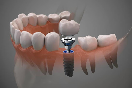 Implantes Dentales Chamartín