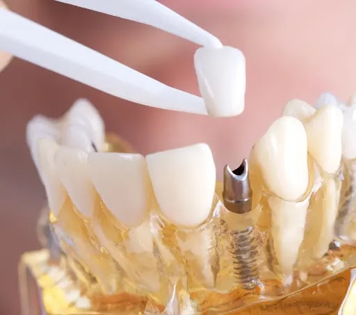 Implantes Dentales Fuencarral